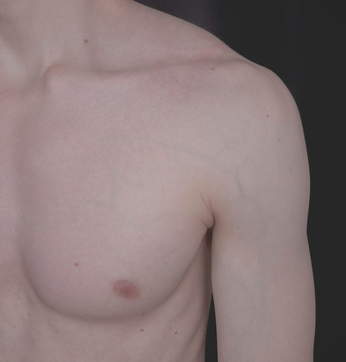 JJ’s top surgery: Part 2