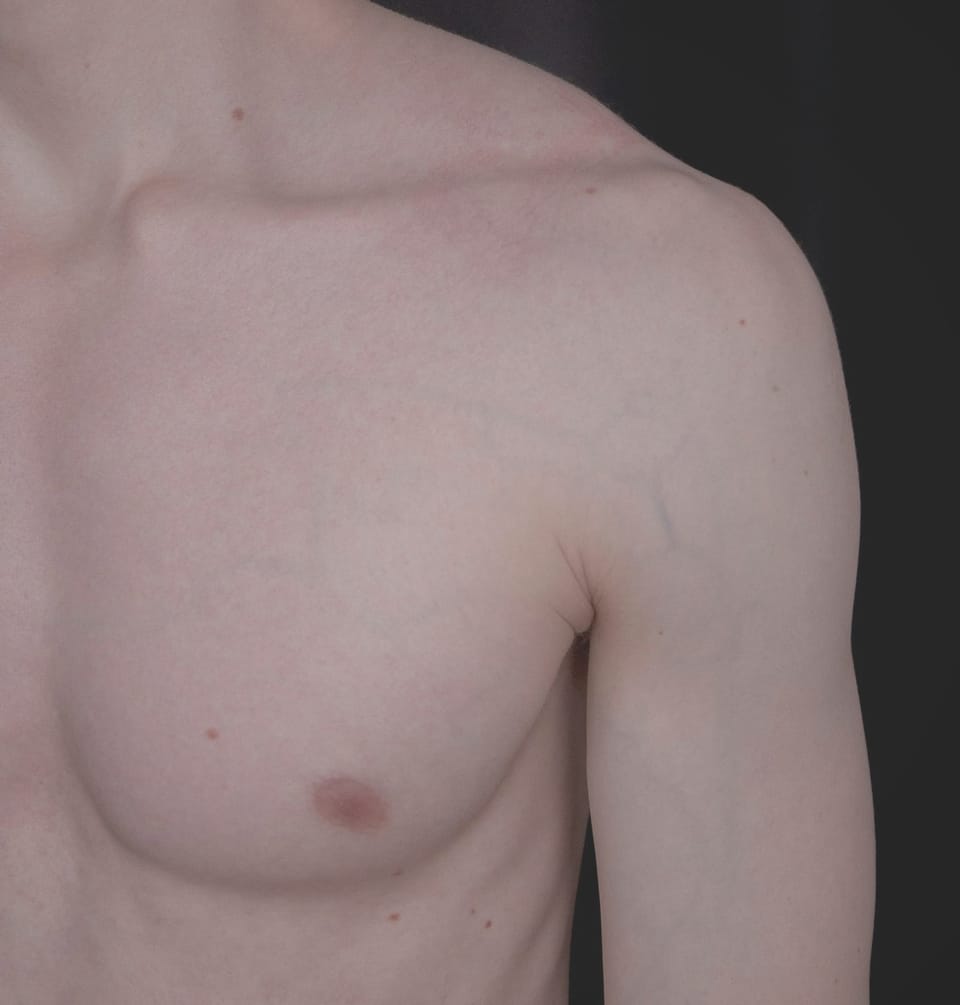 JJ’s top surgery: Part 2